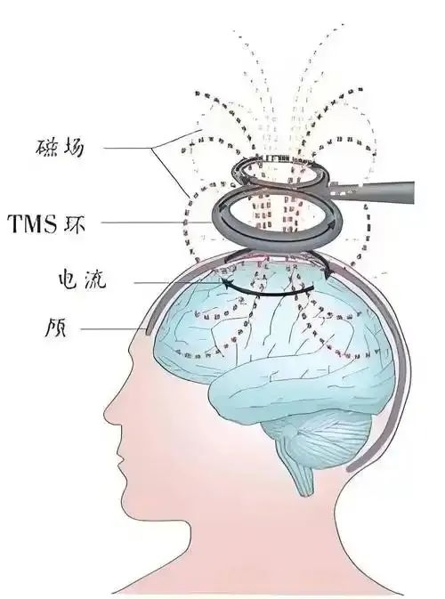 经颅磁与经颅电技术 在儿童青少年精神障碍治疗中的应用与优势